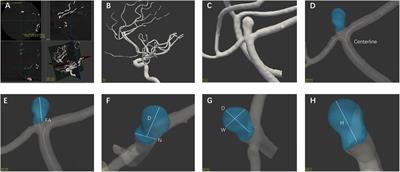 Risk Factors for Pericallosal Artery Aneurysm Rupture Based on Morphological Computer-Assisted Semiautomated Measurement and Hemodynamic Analysis